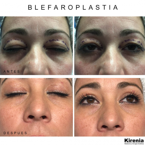 Blefaroplastia